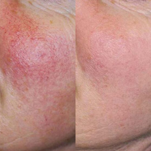 Charger l'image dans la galerie, Photorajeunissement 3-en-1