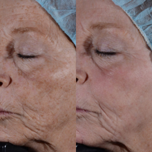 Charger l'image dans la galerie, Photorajeunissement 3-en-1