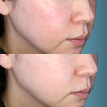 Charger l'image dans la galerie, Microneedling Exo-Glow