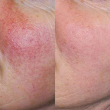 Charger l'image dans la galerie, Laser vasculaire