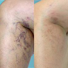 Charger l'image dans la galerie, Laser vasculaire