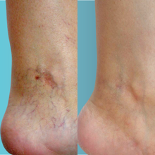 Charger l'image dans la galerie, Laser vasculaire