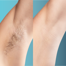 Charger l'image dans la galerie, Épilation définitive, Visage