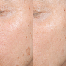 Charger l'image dans la galerie, Photorajeunissement