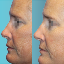 Charger l'image dans la galerie, Raffermissement cutané par Radiofréquence