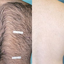 Charger l'image dans la galerie, Épilation définitive, Visage