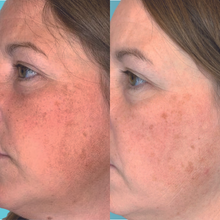 Charger l'image dans la galerie, Microdermabrasion de grade médical