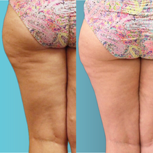 Charger l'image dans la galerie, Stimulation musculaire EmSculpt