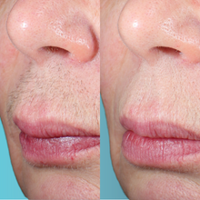 Charger l'image dans la galerie, Épilation définitive, Visage