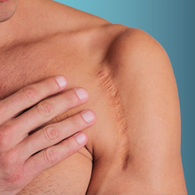 Charger l'image dans la galerie, Microneedling