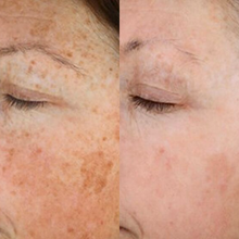 Charger l'image dans la galerie, Photorajeunissement