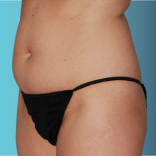 Charger l'image dans la galerie, Radiofréquence corporelle