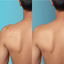 Charger l'image dans la galerie, Microdermabrasion correctrice pour le dos et les épaules