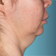 Charger l'image dans la galerie, Radiofréquence corporelle