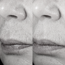 Charger l'image dans la galerie, Épilation définitive, Visage