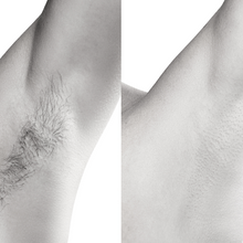 Charger l'image dans la galerie, Épilation définitive, Haut du corps