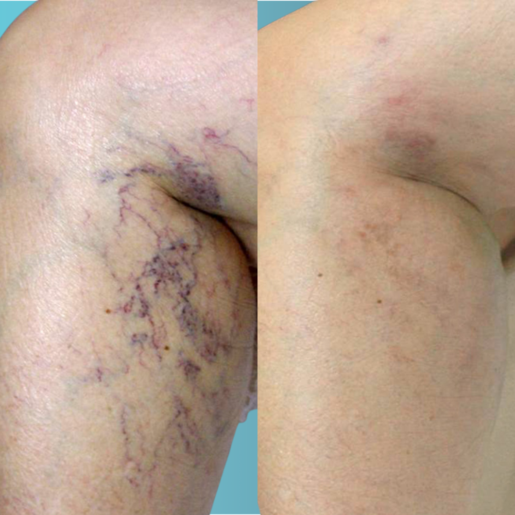 Laser vasculaire